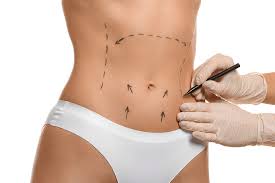 Abdominoplastia — Dr. Marcelo Resende