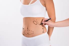 Lipoaspiração — Dr. Marcelo Resende