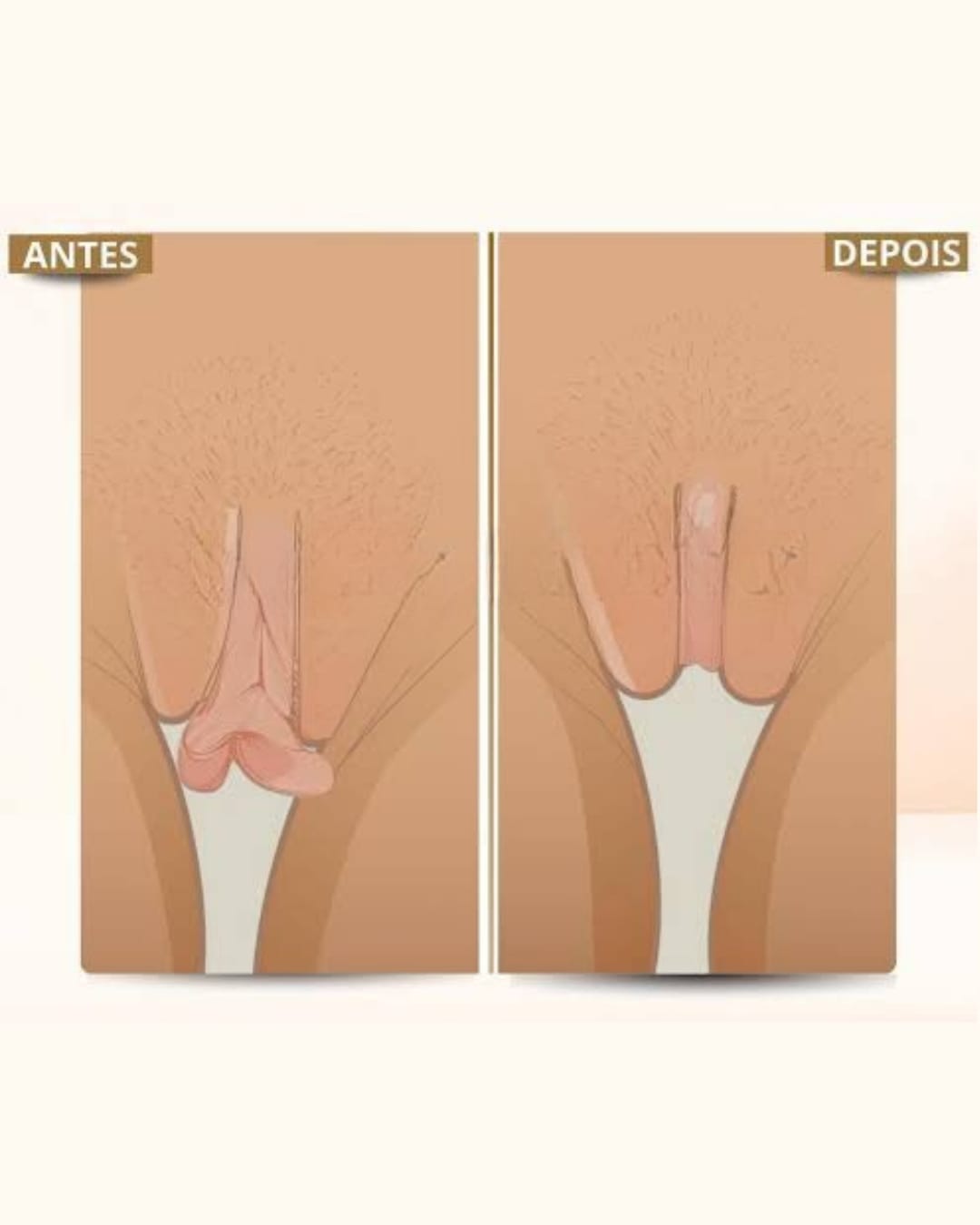 Ninfoplastia — Dr. Marcelo Resende