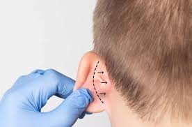 Otoplastia — Dr. Marcelo Resende